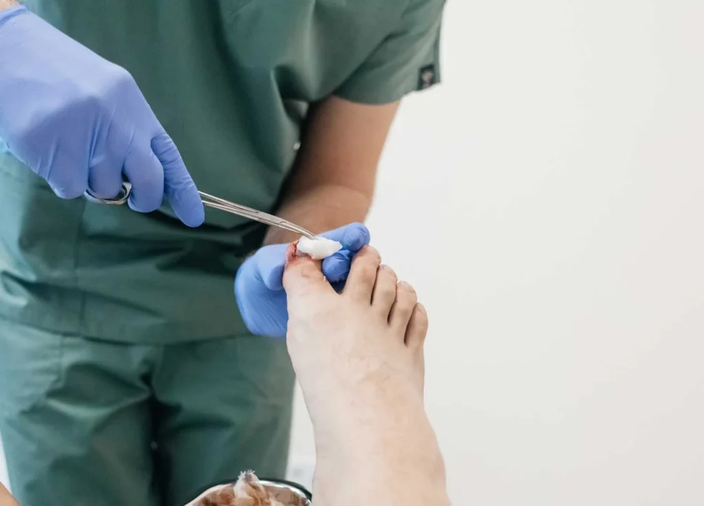 ingrown toenail
