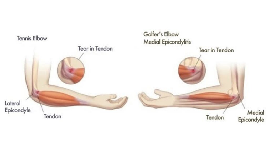 Tennis Elbow and Golfer’s Elbow 1 Tennis Elbow and Golfer’s Elbow