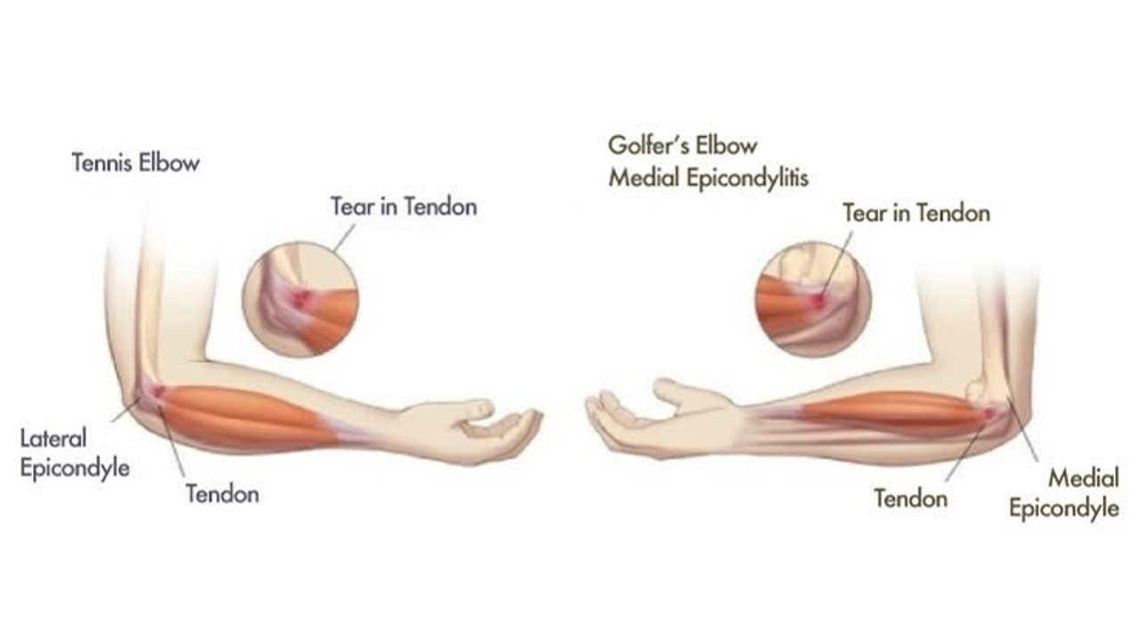Tennis Elbow and Golfer’s Elbow